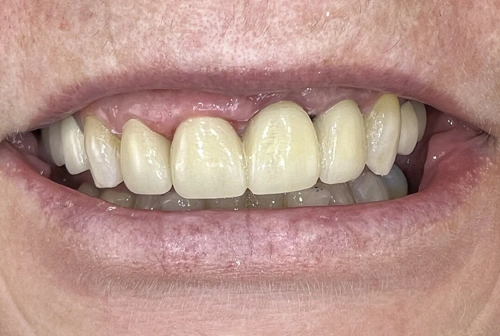 David after dental implants