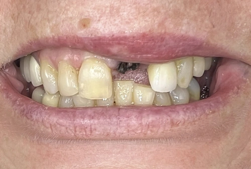 David before dental implants