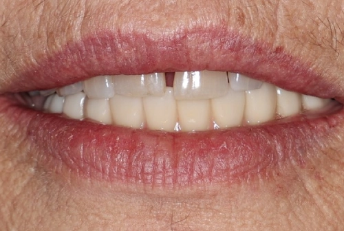 Linda after dental implants