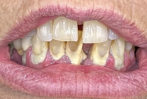 Linda before dental implants