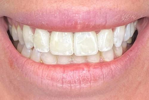 Margaret after dental implants