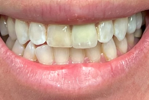 Margaret before dental implants